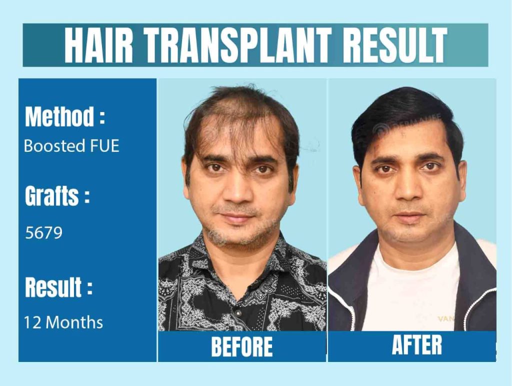 A Comprehensive Guide to Types of Hair Transplants in Delhi celebrity hair transplant Surgeon in India