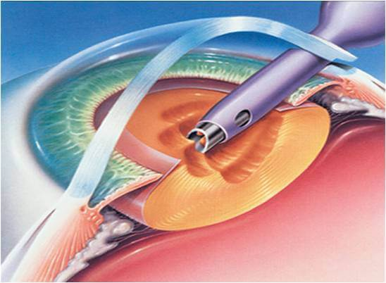 Everything You Need to Know About Cataract Surgery: Procedure, Cost & Recovery Everything You Need to Know About Cataract Surgery